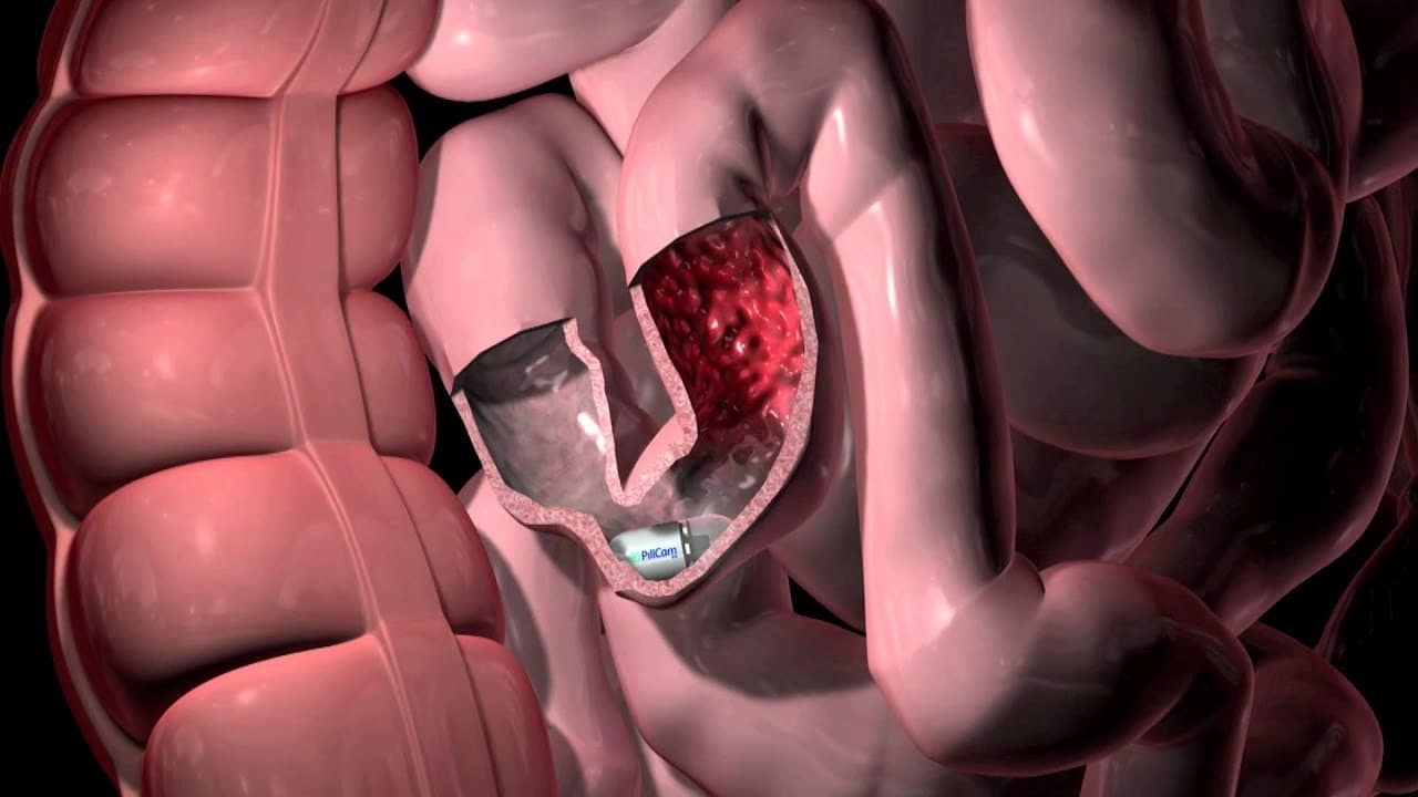 Adieu la coloscopie : il est possible d’avaler une capsule pour prendre des photos de l’intestin et du colon