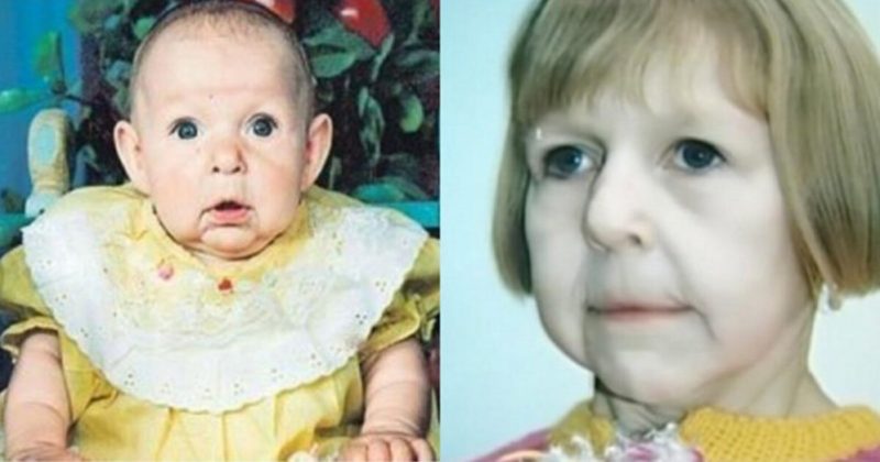 La fille unique qui est née avec le visage de sa grand-mère: comment elle vit maintenant à 25 ans