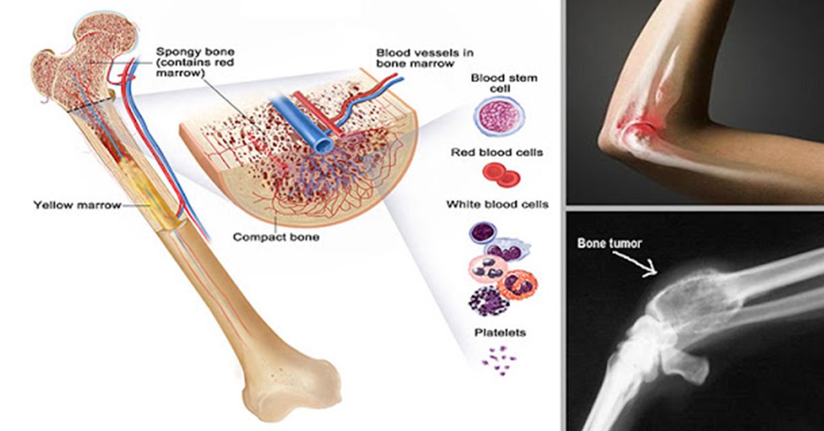 Le cancer des os est un tueur silencieux : 7 remèdes naturels à utiliser en prévention