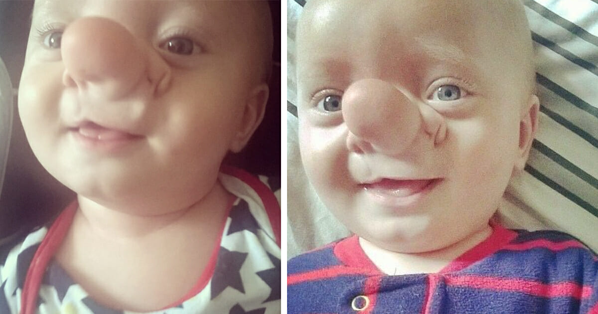 “petit Pinocchio” était moqué pour son nez unique – Voici à quoi il ressemble aujourd’hui, 8 ans plus tard
