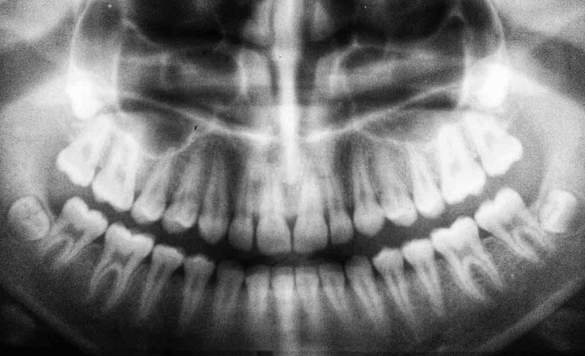 Un utilisateur de TikTok découvre lors d’une visite chez le dentiste que ses os sont devenus noirs