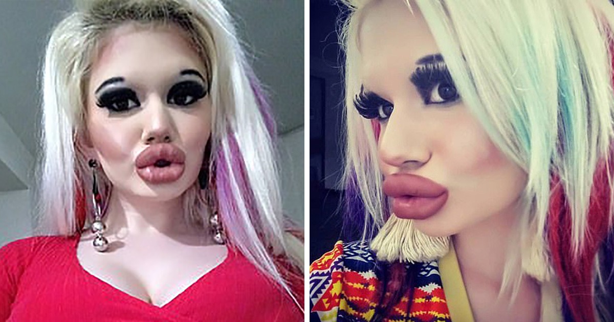 Cette femme a triplé la taille de ses lèvres pour être « plus à la mode »