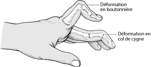 Comment savoir si on souffre d’un main en col de cygne ?