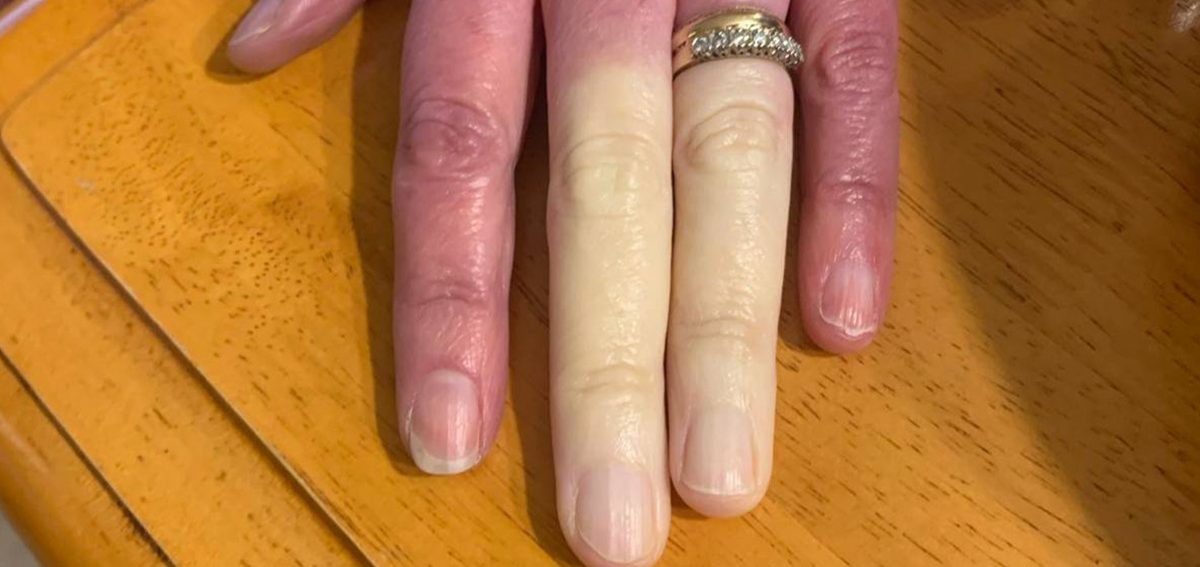 Connaissez-vous la maladie qui rend les doigts blancs ?