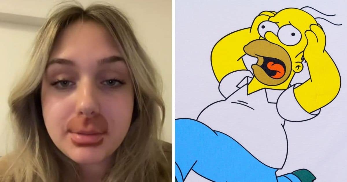 Elle voulait avoir des lèvres pulpeuses et ressemble désormais à Homer Simpson