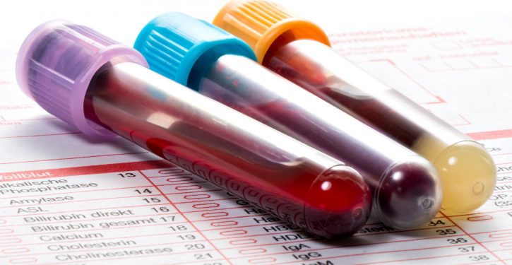 Un nouveau test sanguin pour la fibromyalgie offre de l’espoir à des millions de personnes souffrant de douleurs chroniques