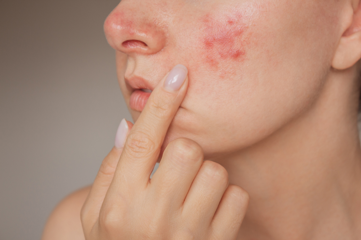 Boutons d’acné : 9 ingrédients top pour réussir à s’en débarrasser