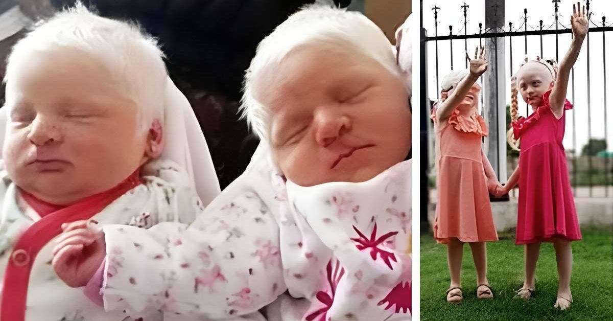 Une femme donne naissance à des jumelles albinos : elles ont grandi pour devenir de magnifiques jeunes filles