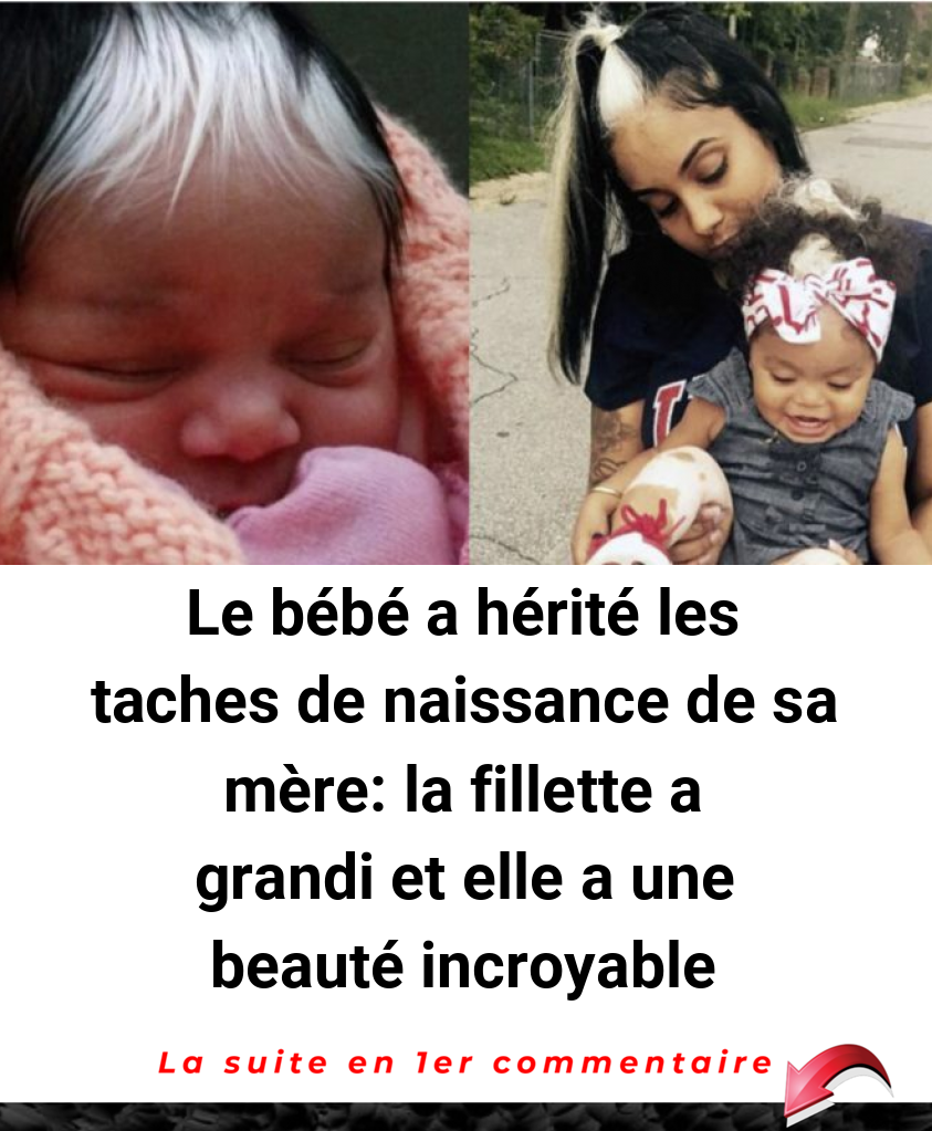 Le bébé a hérité les taches de naissance de sa mère: la fillette a grandi et elle a une beauté incroyable
